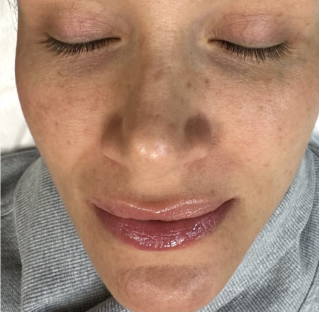 Before Brightening Facial